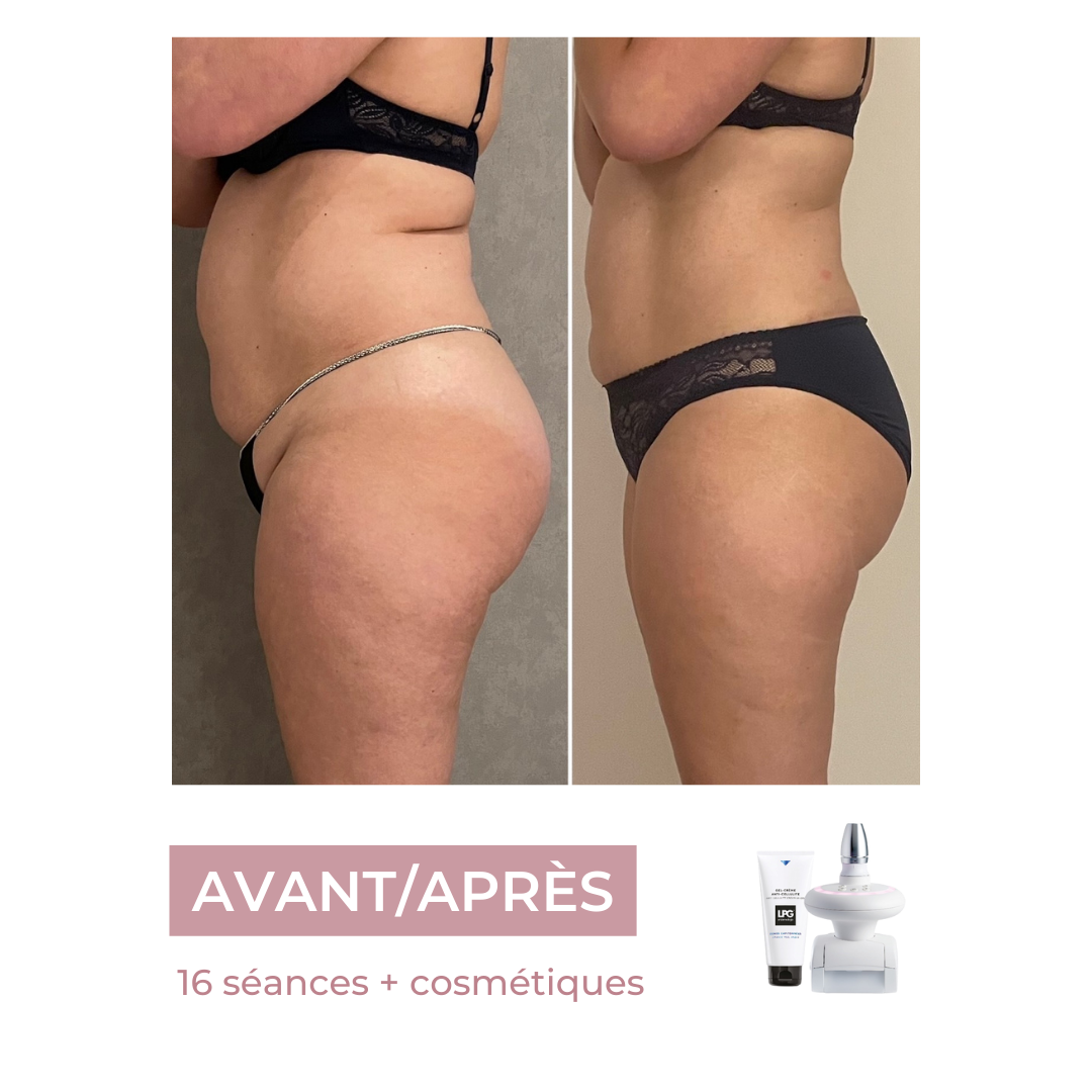 Séance endermologie
